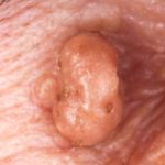 Common_Warts