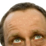 Flat_Warts